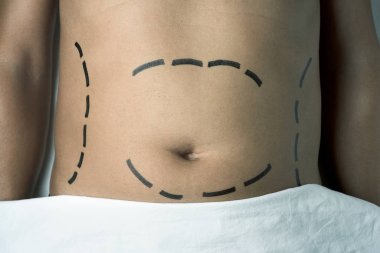 bir plastik cerrahi veya bir liposuction olan adam