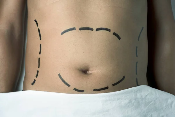 Man met een plastische chirurgie of een liposuctie — Stockfoto