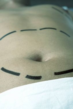 bir plastik cerrahi veya bir liposuction olan adam