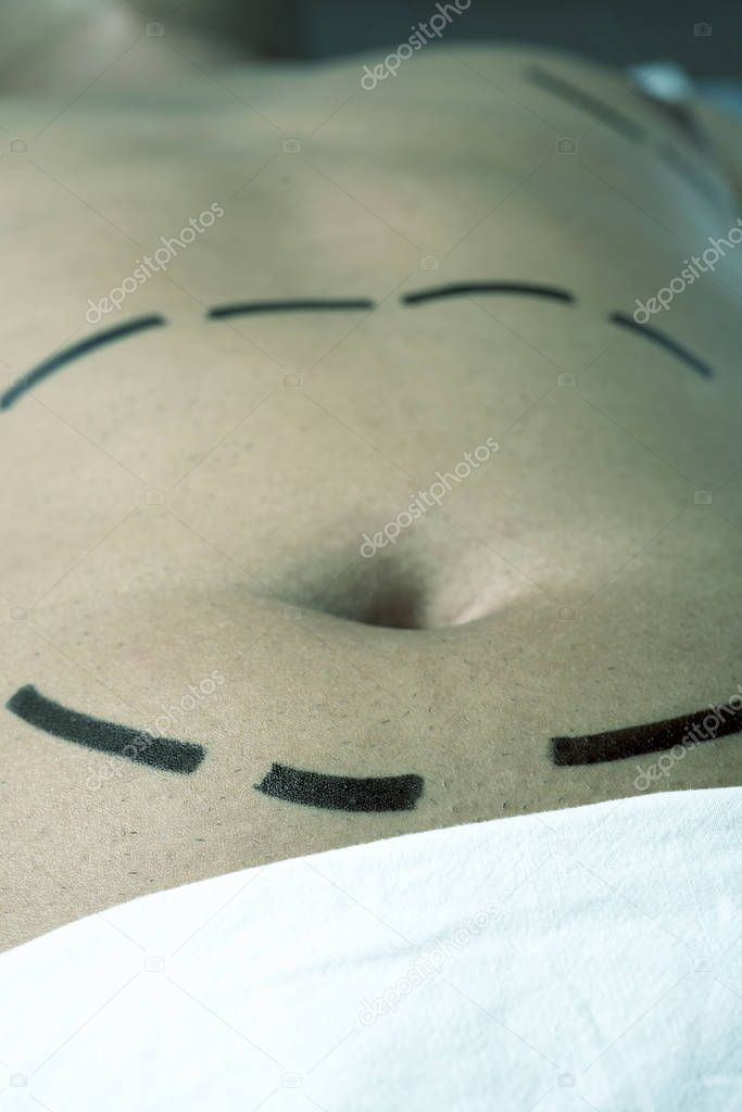 man having a plastic surgery or a liposuction