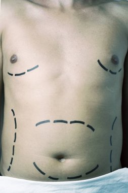 bir plastik cerrahi veya bir liposuction olan adam