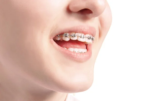 Beautiful young woman with teeth braces Royalty Free Stock Images