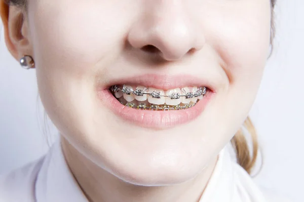 Jovem com aparelho dentário — Fotografia de Stock