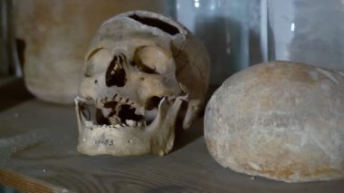 İnsan kafatası bir ecza dükkanında. Bu kafatası ile tıbbi müdahale izleri