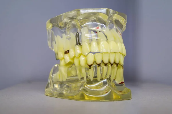 Implantes dentários e dentes no crânio — Fotografia de Stock