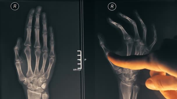 Vrouwelijke arts x-ray afbeelding van een hand tonen aan een patiënt. 4 k close-up shot — Stockvideo