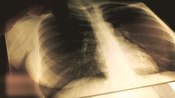 Dokter x-ray foto van een borst uit te leggen aan een patiënt. 4 k close-up shot — Stockvideo