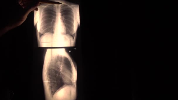 Il dottore spiega l'immagine radiografica di un torace ad un paziente, sfondo nero. Spazio vuoto per grafica o iscrizioni. 4K close-up video — Video Stock