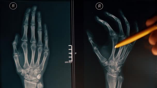 O doutor explica a imagem de raio-x de uma mão a um paciente. tiro de close-up 4K — Vídeo de Stock