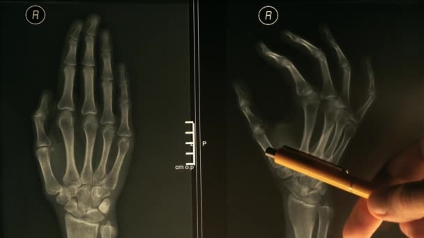 Dokter legt xray afbeelding van een hand een patiënt, warme kleuren. 4 k close-up video — Stockvideo