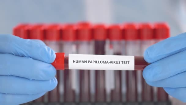 Laboratorieassistent med skyddshandskar håller flaskan med humant papillomvirus test — Stockvideo