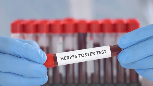 Asistente de laboratorio con guantes de protección sostiene vial con prueba de herpes zoster — Foto de Stock