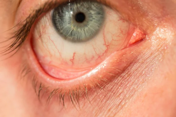The mans eye is gray-blue with red veins on it very close