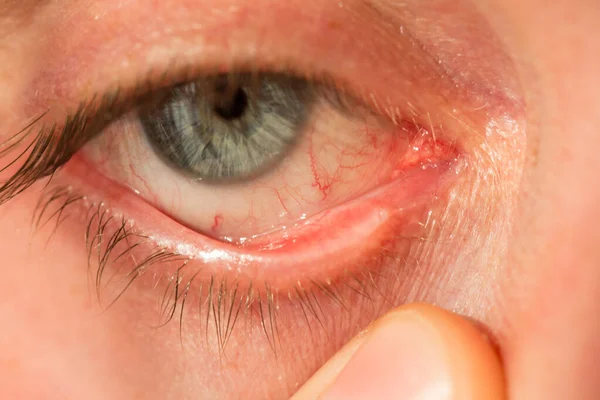 The mans eye is gray-blue with red veins on it very close