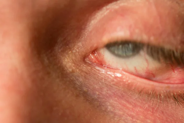 The mans eye is gray-blue with red veins on it very close