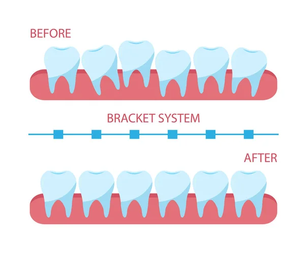 Плакатная кронштейн, плоский стиль. процесс коррекции зубов с ортопедическими скобками . — стоковый вектор