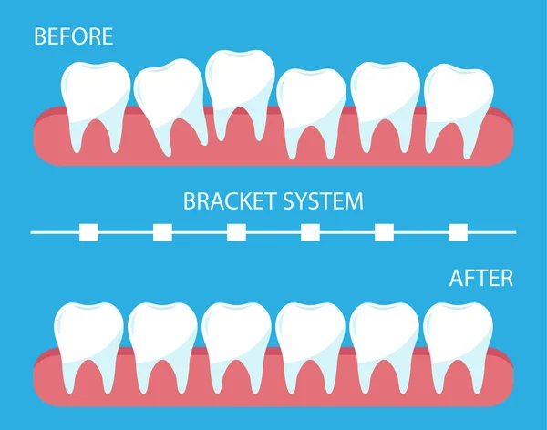 A fogak ortopédiai fogszabályzóval történő korrekciójának folyamata. — Stock Vector