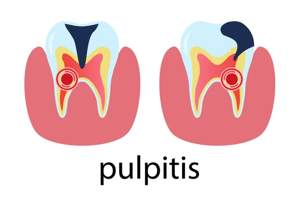 Dental treatment poster pulpitis. Human molar tooth — Stock Vector