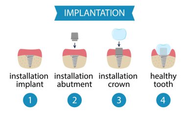 infographics dental implantation. Process of implant installation.