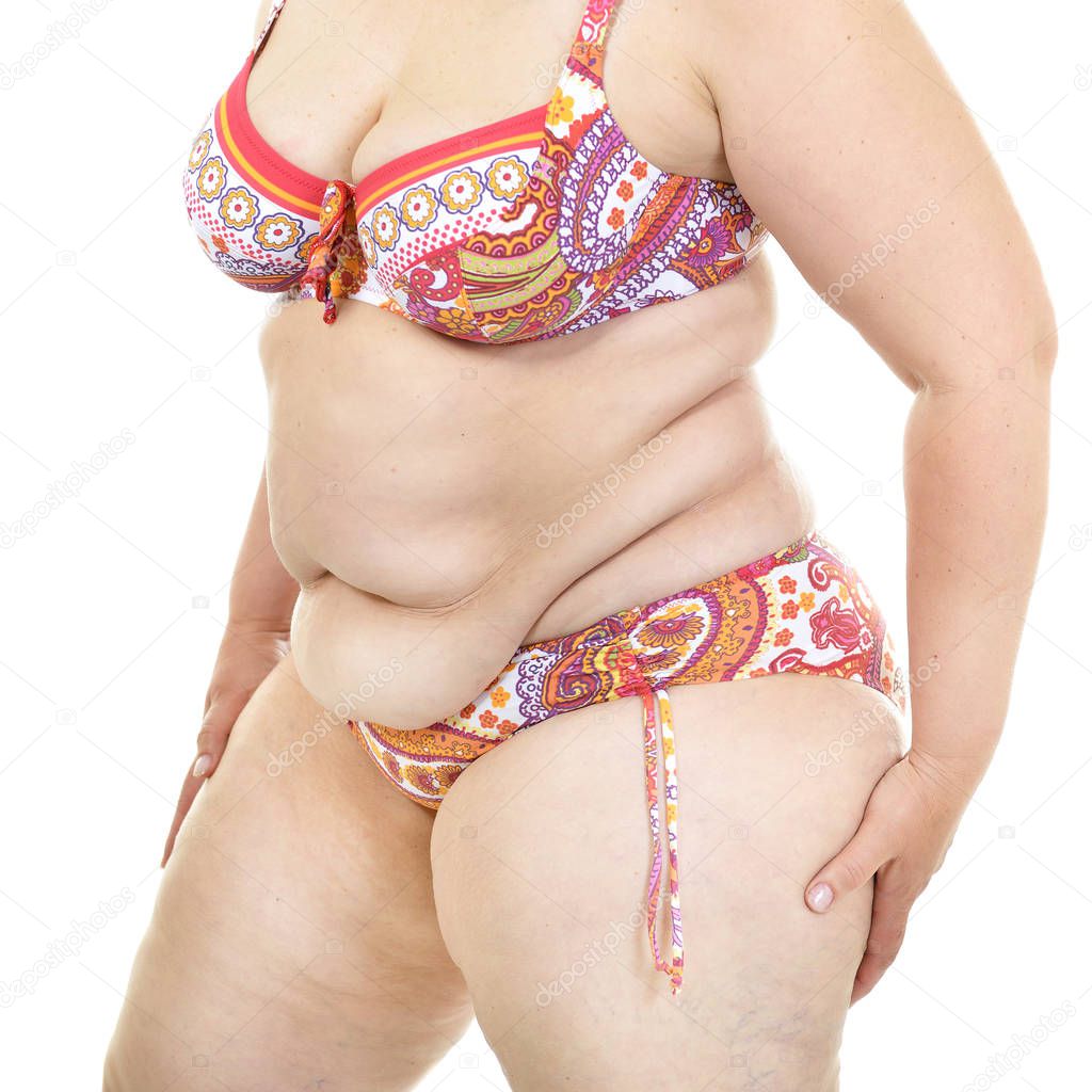 Overweight cellulitis woman