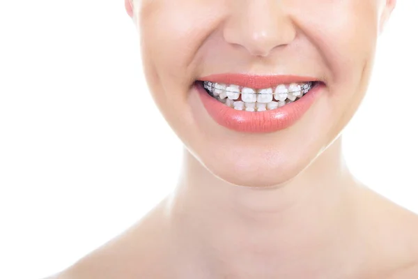 White teeth with braces — Stock Photo, Image