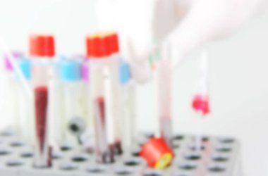 2019 ncov laboratuvar testinde insan enfeksiyonu şüphesi var. Coronavirus hastalığı (Covid-19) daha önce insanlarda tespit edilmemiş yeni bir virüsün yol açtığı bulaşıcı bir hastalıktır..