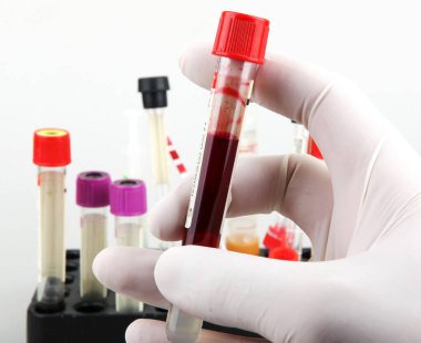 Coronavirus hastalığı (COVID-19) araştırması. Kan testi. Düzenli kan testi genel fiziksel sağlığınızı korumanın en önemli yollarından biridir..