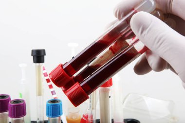 Coronavirus hastalığı (COVID-19) araştırması. Kan testi. Düzenli kan testi genel fiziksel sağlığınızı korumanın en önemli yollarından biridir..