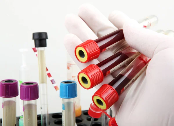 コロナウイルス病 Covid 血液検査 定期的な血液検査は 身体全体の健康を追跡するための最も重要な方法の1つです — ストック写真