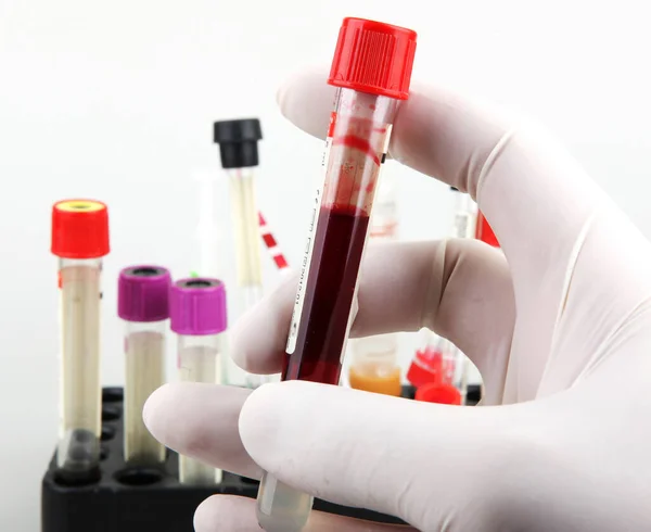 Исследование Коронавирусной Болезни Covid Анализ Крови Регулярный Анализ Крови Является — стоковое фото