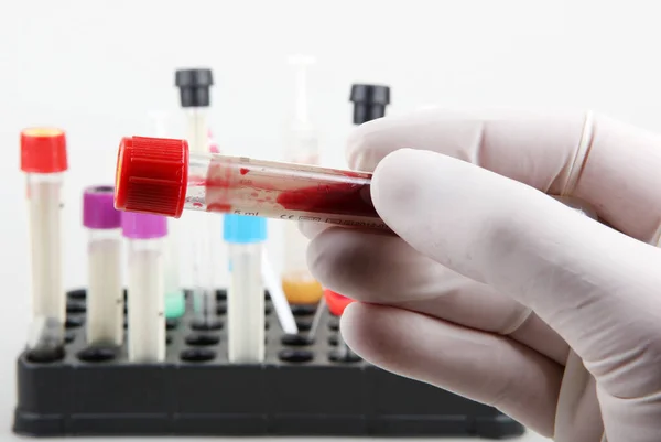 Coronavirus Hastalığı Covid Araştırması Kan Testi Düzenli Kan Testi Genel — Stok fotoğraf