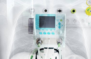Akciğerin zatürree ve yoğun bakım solunum cihazıyla x-ray görüntüsüne çifte maruz kalma.