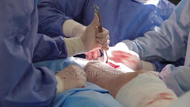 Манипуляции для протезирования тазобедренного сустава — стоковое видео