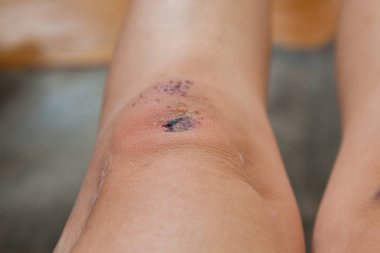 Bir sonbaharda neden diz çizik.