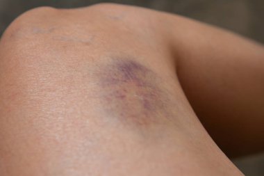 Bir sonbaharda neden diz çizik.