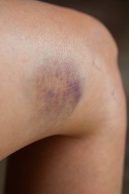 Bir sonbaharda neden diz çizik.