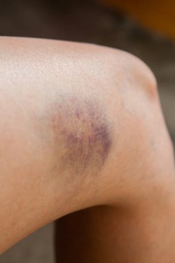 Bir sonbaharda neden diz çizik.