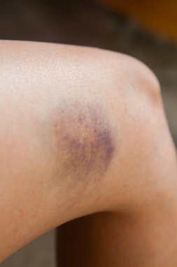 Bir sonbaharda neden diz çizik.