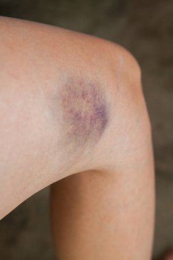 Bir sonbaharda neden diz çizik.