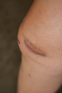 Bir sonbaharda neden diz çizik.