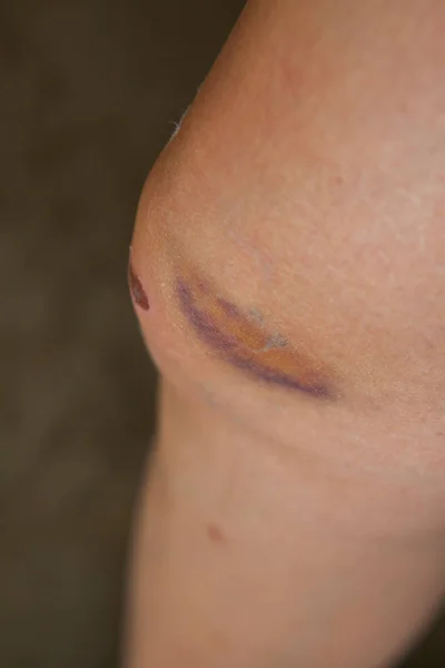 Scratch on the knee caused by a fall. — Stock Photo, Image