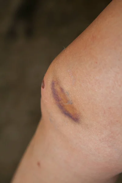 Arranhão no joelho causado por uma queda . — Fotografia de Stock