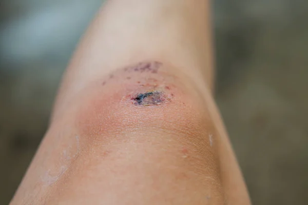 Rasguño en la rodilla causado por una caída . — Foto de Stock