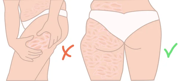 Celulitis antes y después de los resultados . — Vector de stock