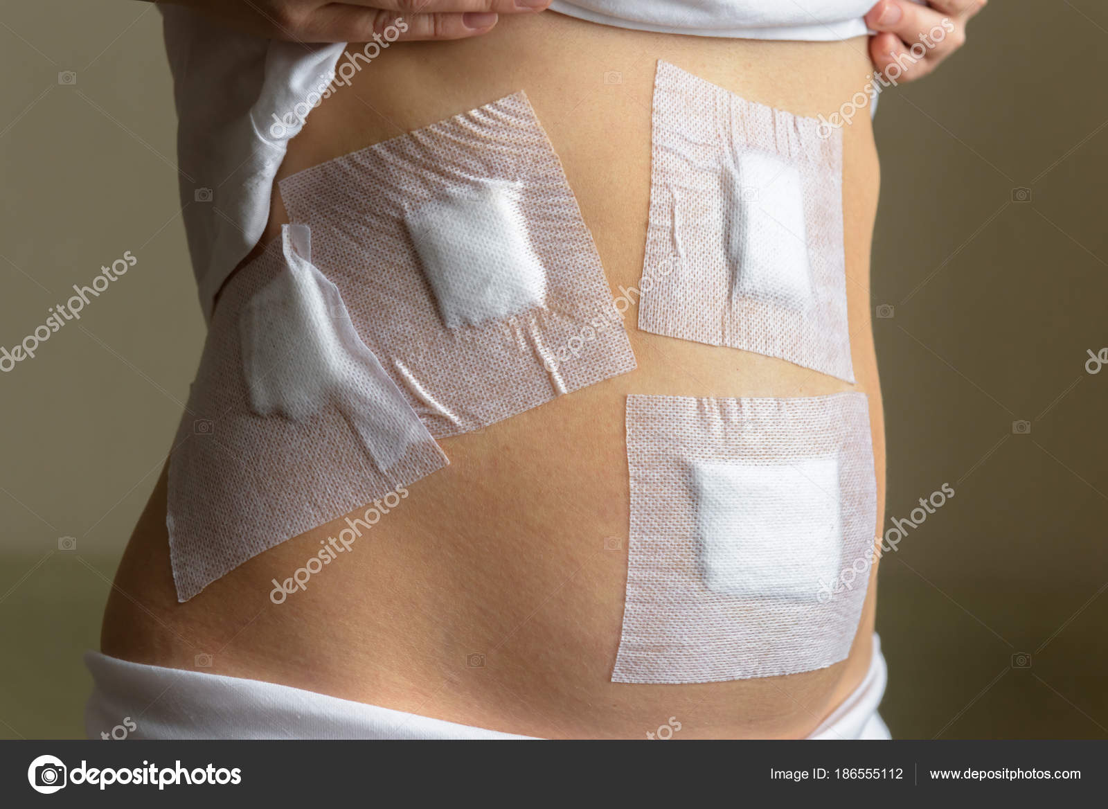 Operacion de vesicula por laparoscopia postoperatorio