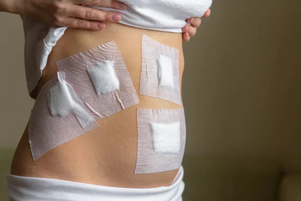 Genç kadının karnında işlemi laparoskopi bir Kliniği tarafından sonra — Stok fotoğraf