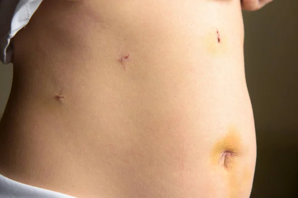 El abdomen con puntos médicos después de la cirugía por laparoscopia —  Fotos de Stock