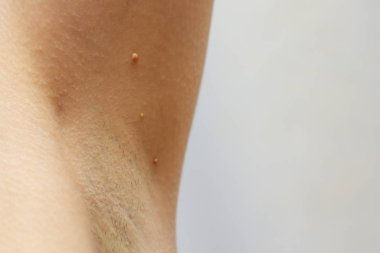 papillomas in the armpit on skin, close up clipart