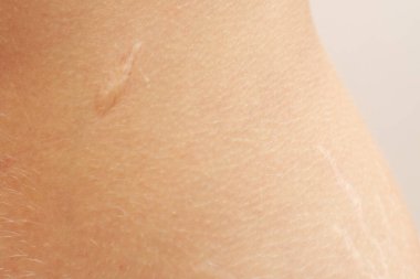 Deride ameliyat izleri ve ciltte gerilme izleri var.