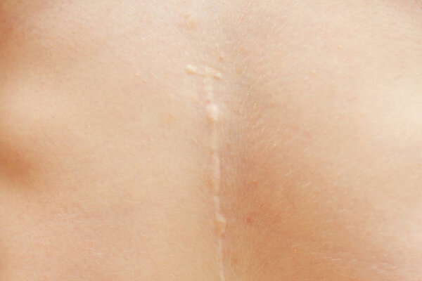 large scar on the skin of the abdomen from surgery